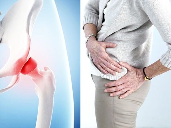symptoms of osteoarthritis of the hip
