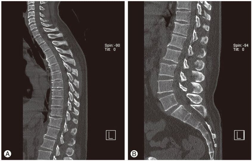 Deformation of the intervertebral discs of MRI images in thoracic osteochondrosis